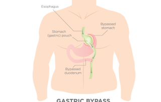Recovering From Gastric Bypass Surgery