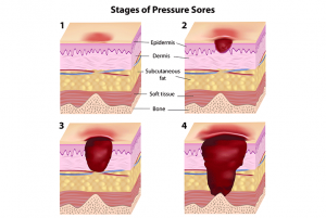 How To Help Wheelchair Patients Prevent Pressure Ulcers