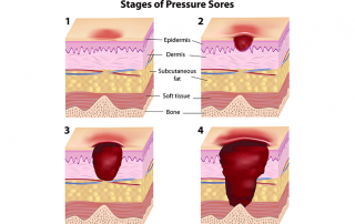 How To Help Wheelchair Patients Prevent Pressure Ulcers