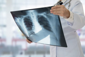 Knowing These 3 Signs of Pneumonia Could Help Save Your Life