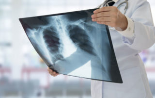 Knowing These 3 Signs of Pneumonia Could Help Save Your Life