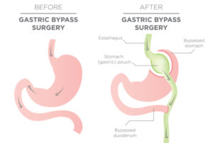 Is Bariatric Surgery Painful? Plus, Answers to Other Frequently Asked Questions About Weight Loss Surgery
