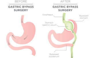 Is Bariatric Surgery Painful? Plus, Answers to Other Frequently Asked Questions About Weight Loss Surgery